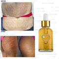 STRETCH MARKS REMOVER CREAM SERUM, WORKS 100%, REMOVES STRETCH MARKS IN 2 WEEKS !