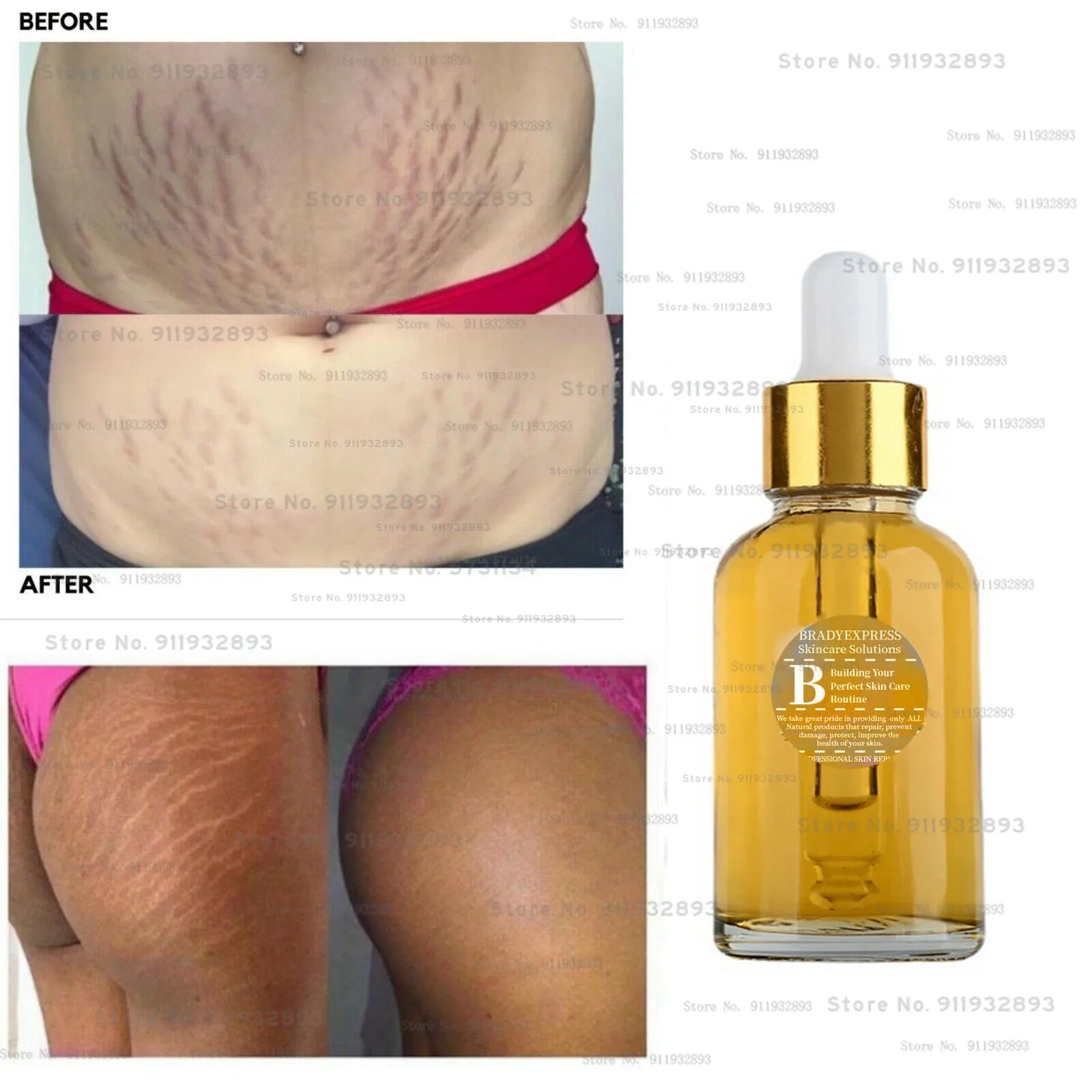STRETCH MARKS REMOVER CREAM SERUM, WORKS 100%, REMOVES STRETCH MARKS IN 2 WEEKS !