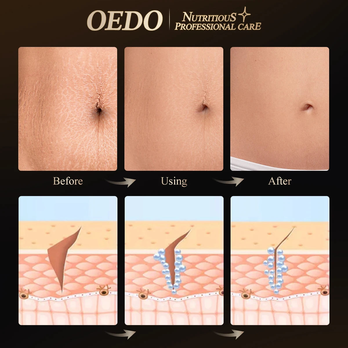 OEDO Stretch Mark Cream Remove Stretch Marks Skin Repair For Pregnant Women Remove Wrinkles Firm Skin Body Lotion Body Care