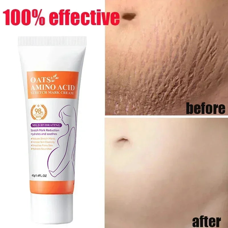 Stretch Marks Permanent Removal Cream Eliminate Body Belly Stretch Marks Swelling Marks Remove Skin Cracks Repair Firming Care