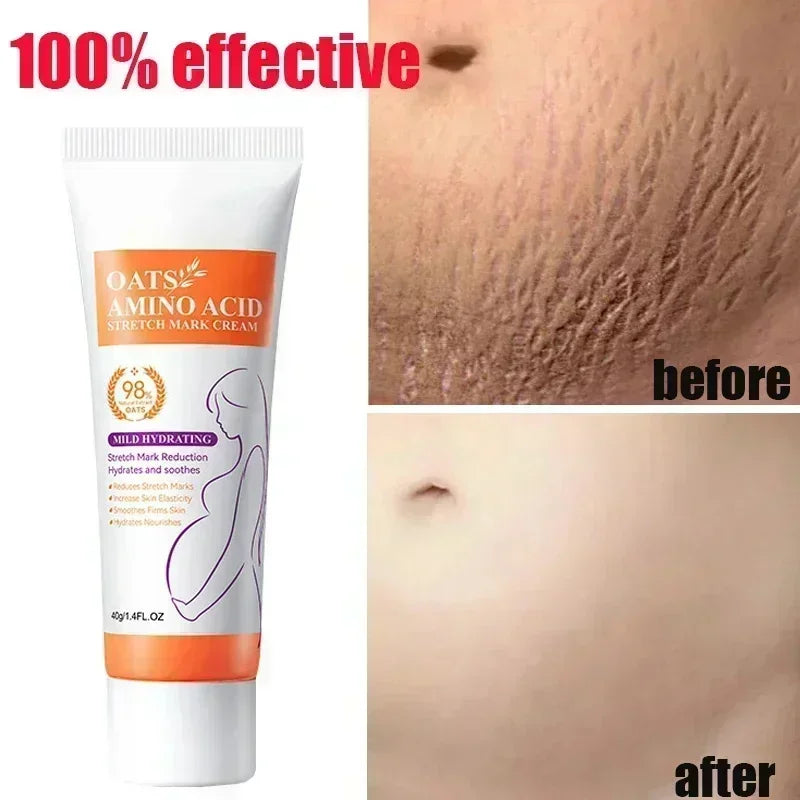 Maternity Stretch Mark Permanent Removal cream Brighten Anti-Winkle Smooth Repair Firming Restore Skin Elasticity Body Skin Care