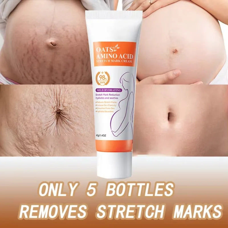 Maternity Stretch Mark Permanent Removal cream Brighten Anti-Winkle Smooth Repair Firming Restore Skin Elasticity Body Skin Care