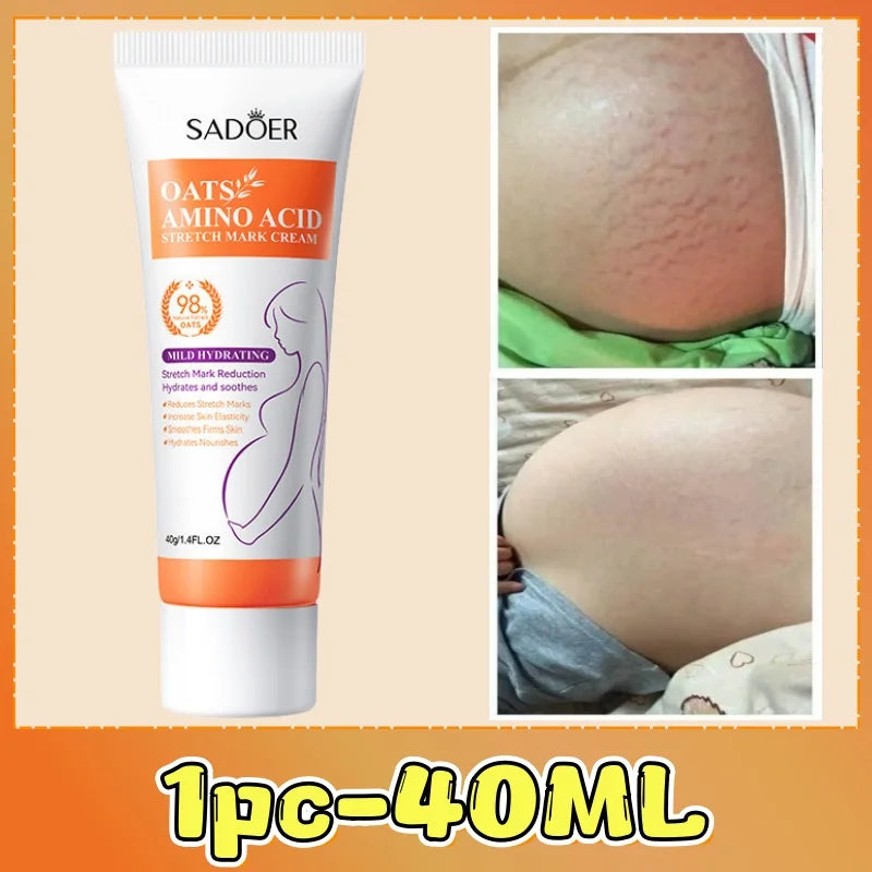 Stretch Marks Permanent Removal Cream Eliminate Body Belly Stretch Marks Swelling Marks Remove Skin Cracks Repair Firming Care