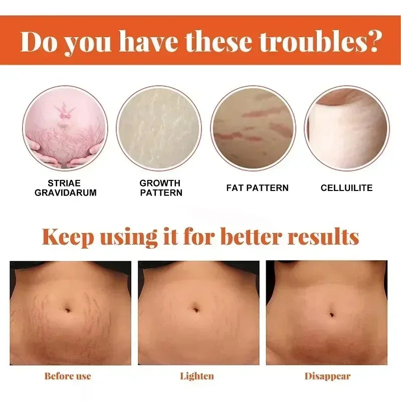 Stretch Mark Vanishing Cream Remove Body Buttock Breast Marks Effective Repair Maternity Loose Firming Skin Care