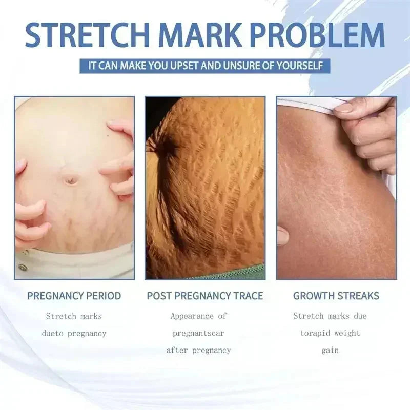 Maternity Stretch Mark Permanent Removal cream Brighten Anti-Winkle Smooth Repair Firming Restore Skin Elasticity Body Skin Care