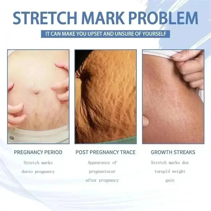 Cream For Pregnancy Stretch Marks Removal Eliminate Red White Old Stretch Marks  2025