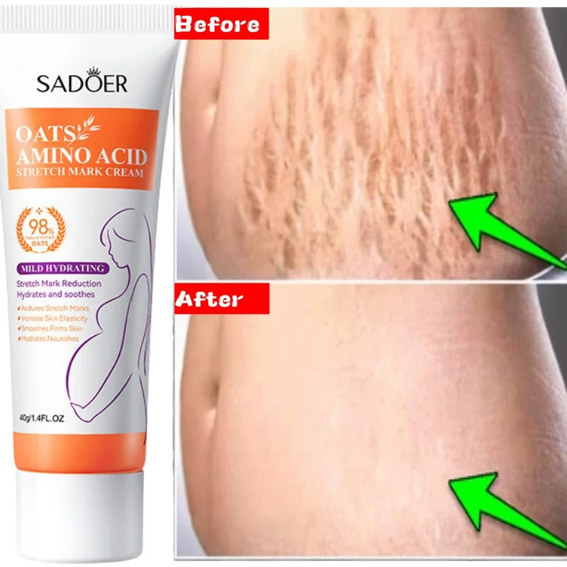 Stretch Marks Permanent Removal Cream Eliminate Body Belly Stretch Marks Swelling Marks Remove Skin Cracks Repair Firming Care